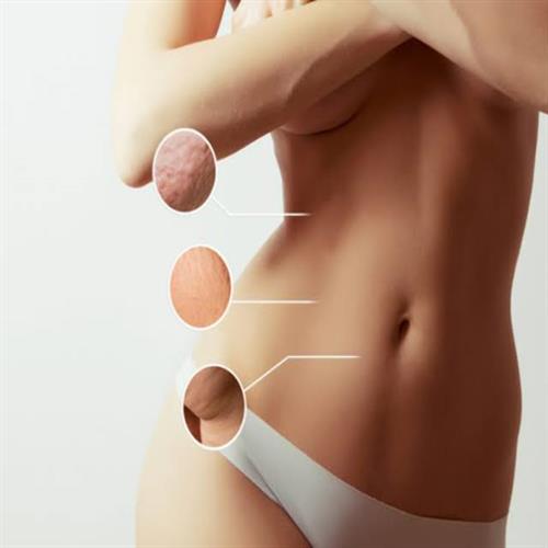 Liposuction , clinicways, Liposuction turkey, Liposuction about,Liposuction